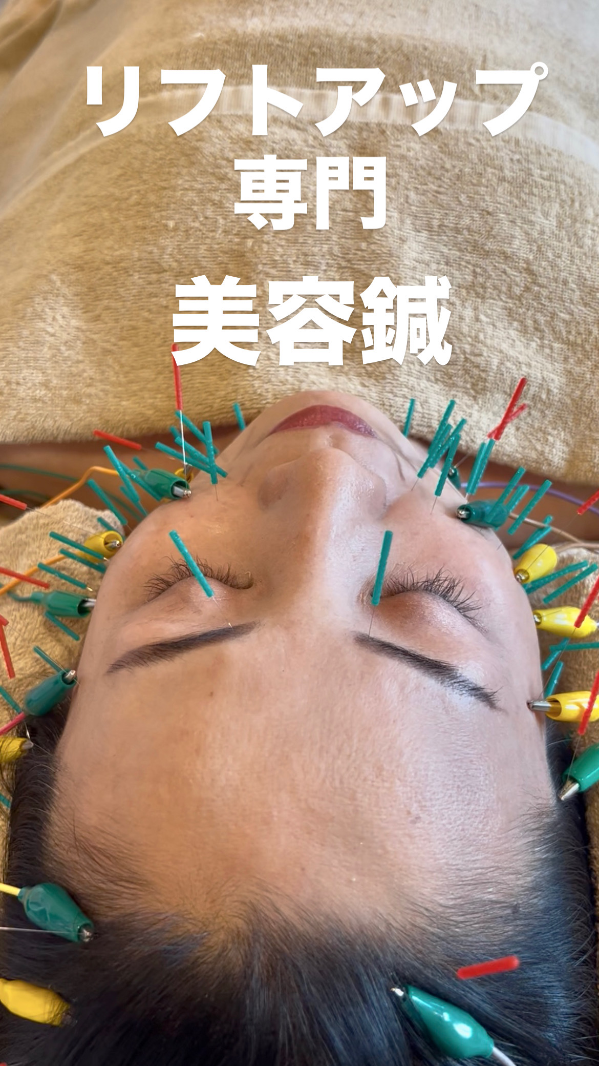 口角が下がる原因と、驚きの美容鍼効果とは？