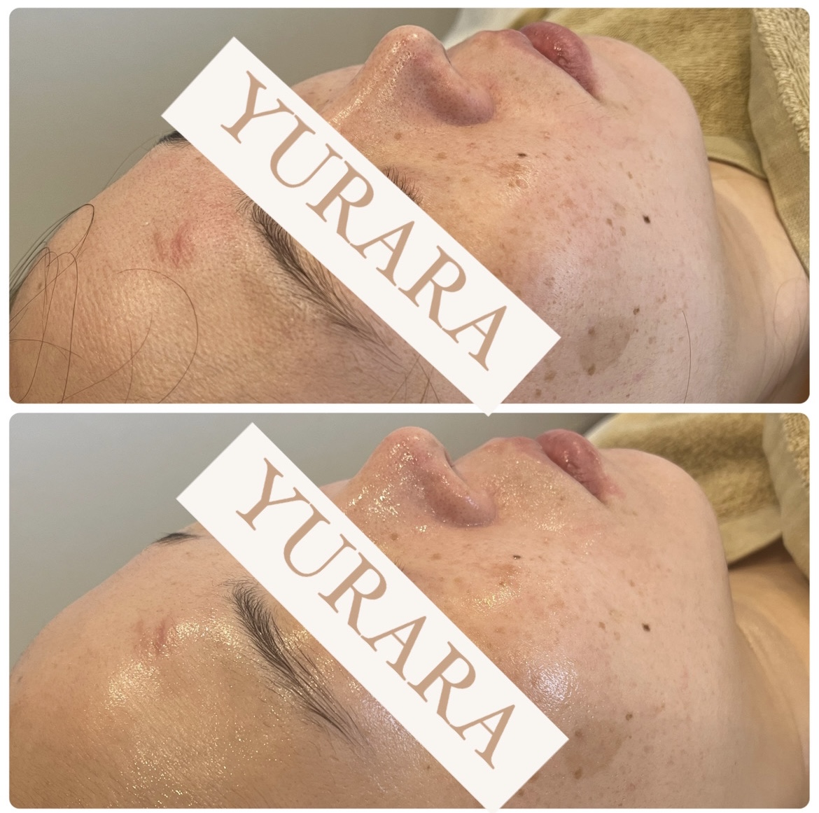 なぜ毛穴がたるむのか??